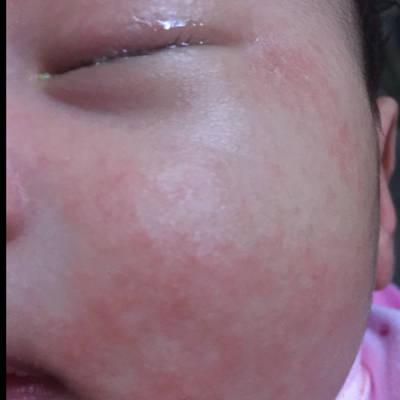 宝宝48天,最近脸上出现红疹子,眼睛有黄色眼屎,不知是过敏还是热的