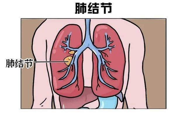 我们做胸部ct检查有时候报告提示肺结节,许多人对此不太明白,其实肺