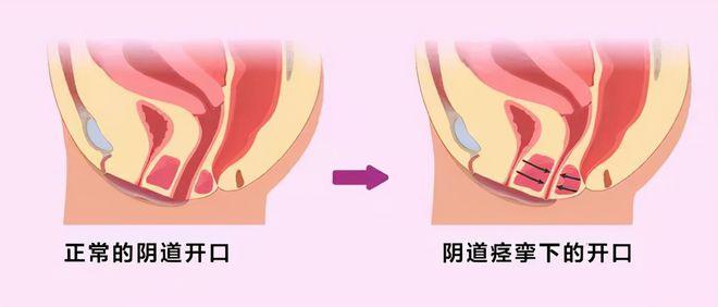 传统上,咱们说阴道痉挛是指阴道口周围的骨盆底肌发生不自主收缩.