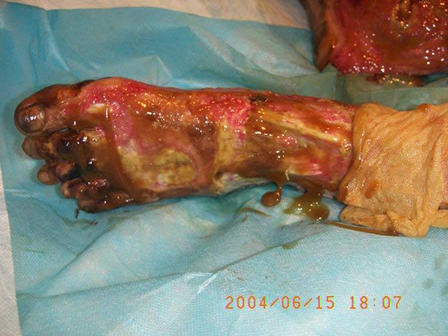 伤后36天患者左足深三度创面裸露的肌腱上有大量肉芽组织生长