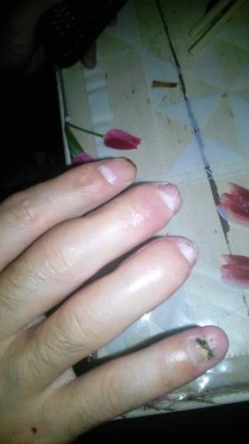 我的手指皮马达的皮带勒伤,中指,无名指,小指动不了,骨折,请问是几级