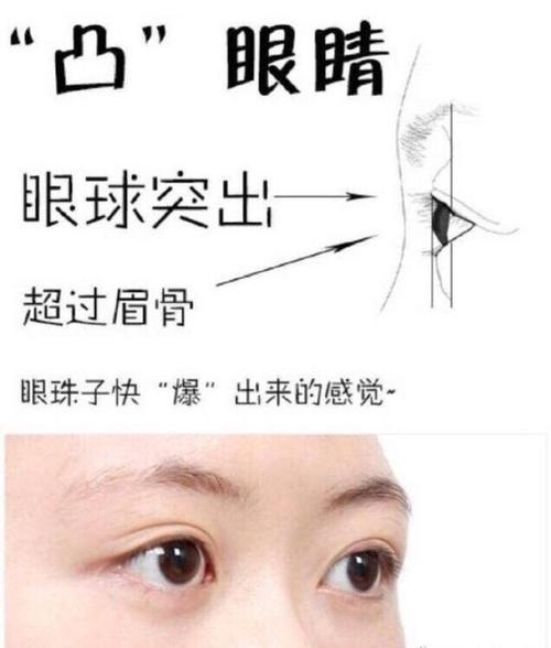 眼球突出是很多亚洲人的特点,眼球突出的原因主要有两_圈子-新氧美容