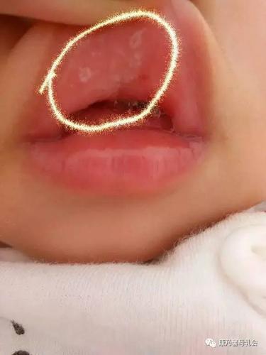 鹅口疮是婴幼儿口腔的一种常见疾病,在口腔黏膜表面形成白色斑膜,擦