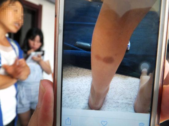 女童母亲向记者展示自己拍摄的照片,6月23日时小红的左腿上有明显的掐