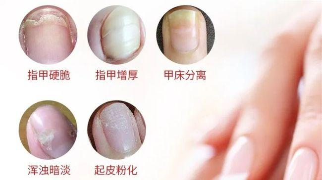 这些灰指甲治疗方法竟是错的!皮肤科专家给出3个建议!