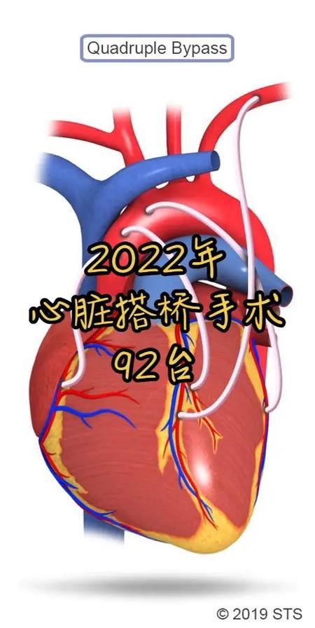 心脏搭桥手术.【我们的2023】 #心脏搭桥手术 92台,绝 - 抖音
