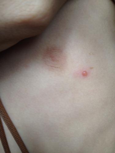 我弟弟今天早上起床发现身上有很多这种痘痘,,有点痒,抓破了有水流出