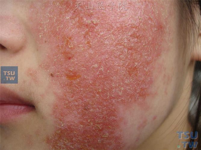 湿疹(eczema)的症状表现