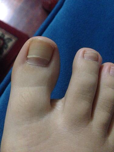 脚指甲上指甲分了两层,新长来的指甲很健康,原来的指甲泛黄.