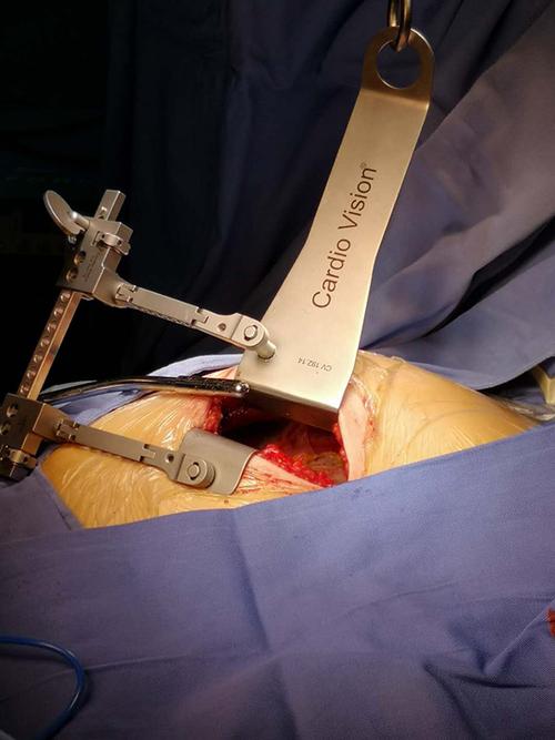 搭桥术,手术效果明显,标志着我院心脏外科在心外科微创搭桥领域达到