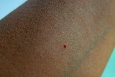 皮肤上长了很多小红点,像小红痣,不痛不痒的是怎么回事儿?