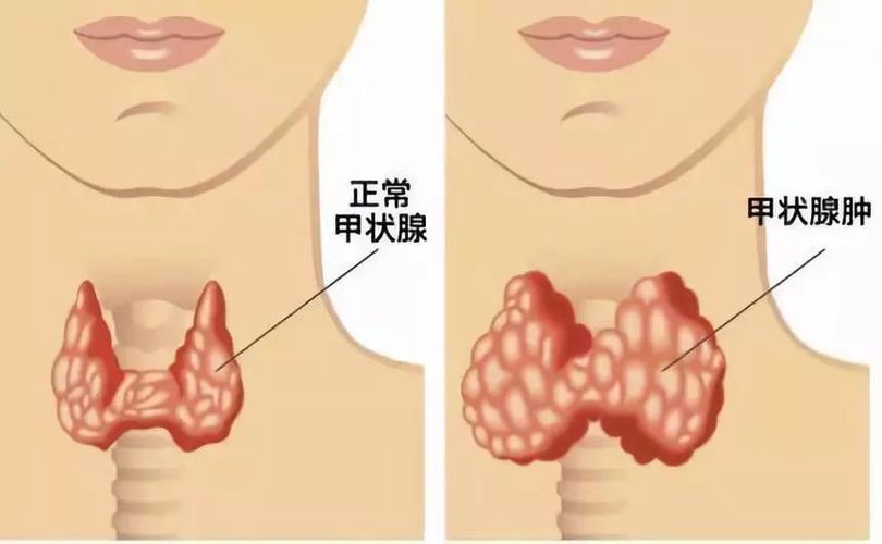 咽口水时,再摸一摸甲状腺对应在脖子上的位置,看看能不能摸到硬硬的小