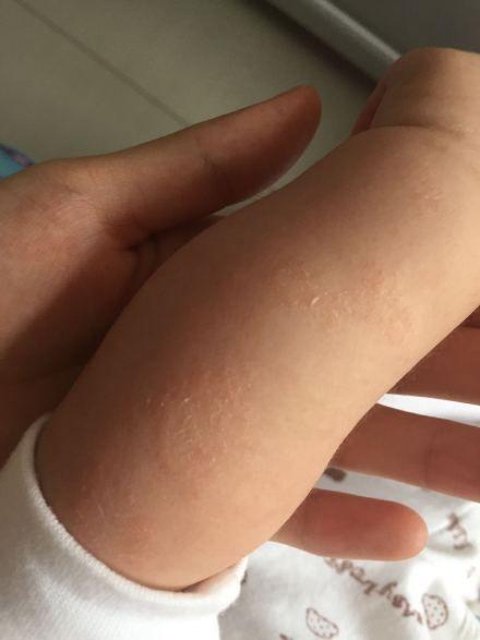 董红红(北京和睦家医院儿科医生):皮肤干燥,有如图的皮疹,考虑湿疹