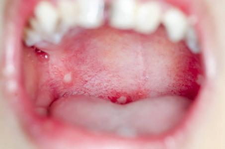 感染的口腔内溃疡照片