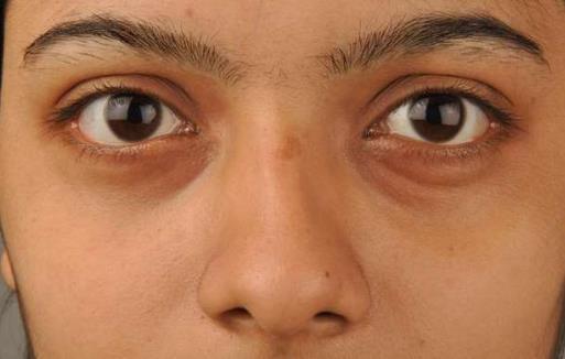 黑眼圈不仅是因为肾虚黑眼圈透露你身体的健康问题