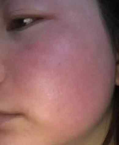 脸部浮肿是疾病的前兆吗?