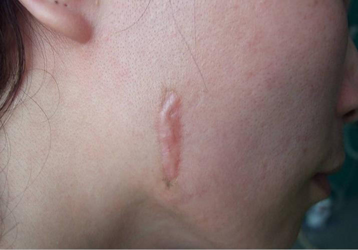 增生性疤痕是怎么出现的有哪些治疗方法