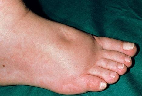 脚肿是什么原因引起的该怎么治疗「脚肿是什么原因引起的?」_友友