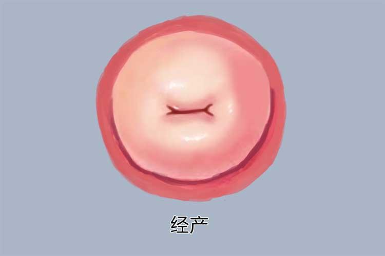 子宫颈外口通阴道,未产妇的子宫颈外口多为圆形,已产妇的子宫颈外口为