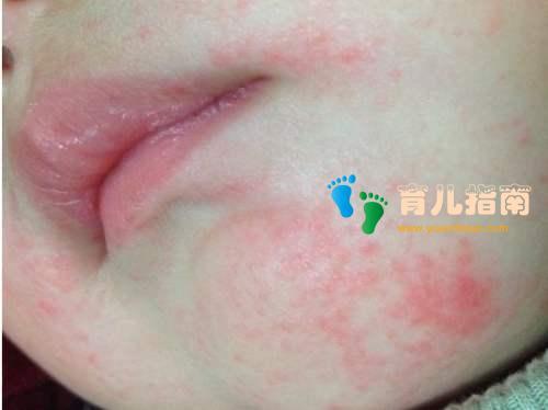 如果口水疹并不是太严重,宝宝只有轻微的红斑,丘疹,家长们只需做好