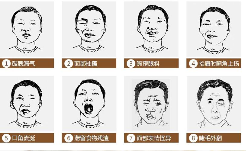 上海健桥医院:面神经炎的症状有哪些?