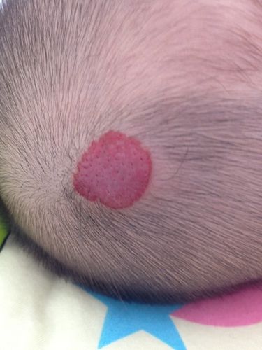 问:有关血管瘤的问题 宝宝7个月,出生时头皮上有块红色的斑点,42天