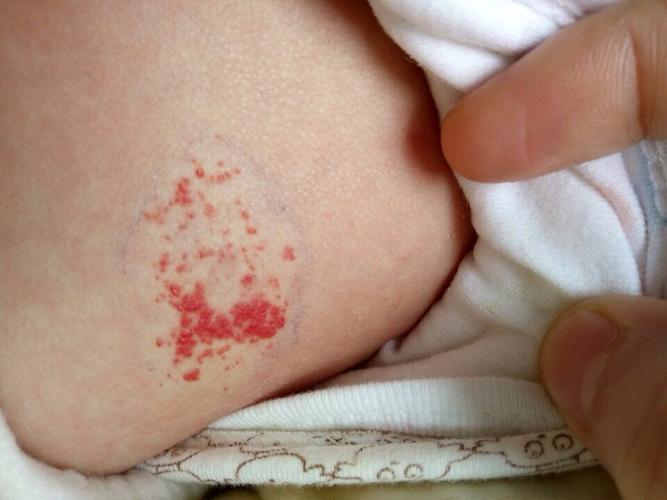 宝宝背上有块草莓状血管瘤 怎么办 有谁遇到过?