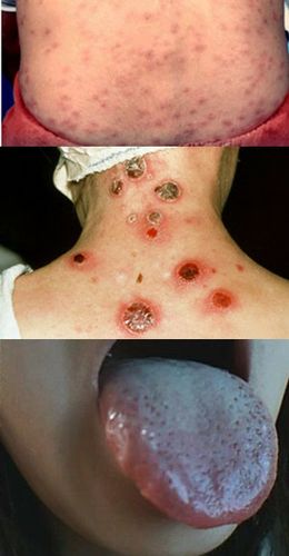 梅毒图片关于梅毒的早期症状图片