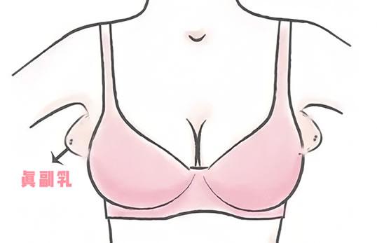 女性副乳长什么样子图片(先天副乳和后天副乳要分清)