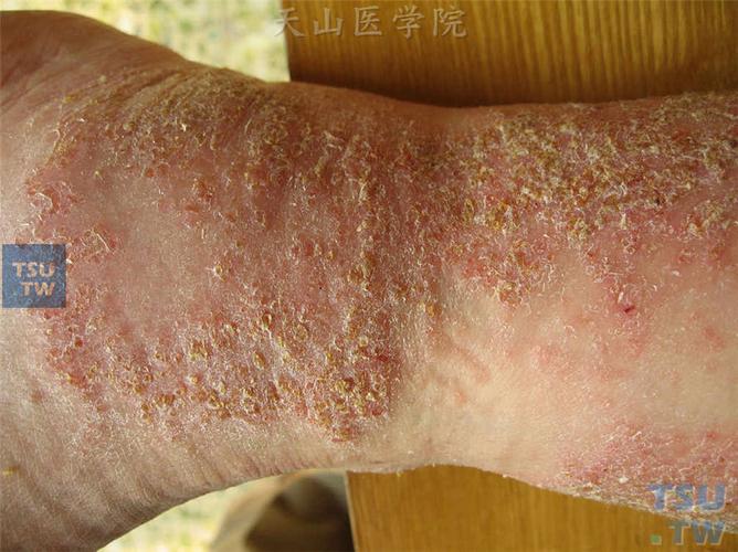 湿疹(eczema)的症状表现