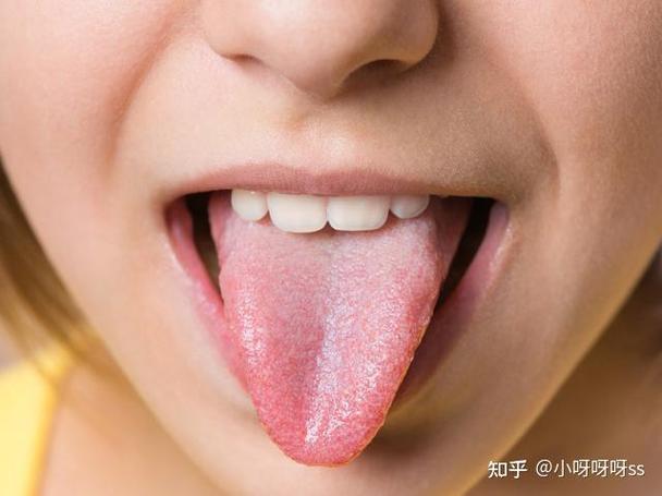 舌头发麻是不是灼口综合征? - 知乎