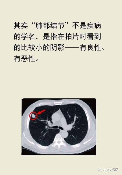 肺内三公分以内的病状都可以叫肺结节.