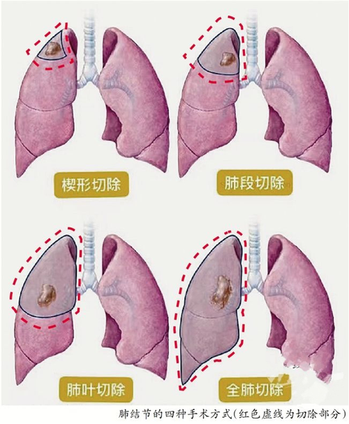 肺结节的手术策略_肺部结节_肺部结节缓解方法 - 好大夫在线