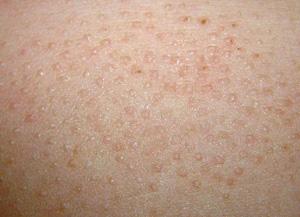 这是一种遗传性皮肤病,主要是由于毛囊口角化所致,与脂肪代谢有很大的
