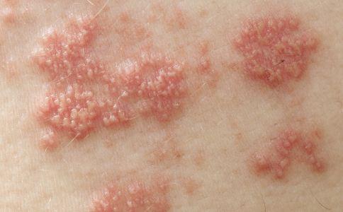 二期梅毒皮疹症状图片
