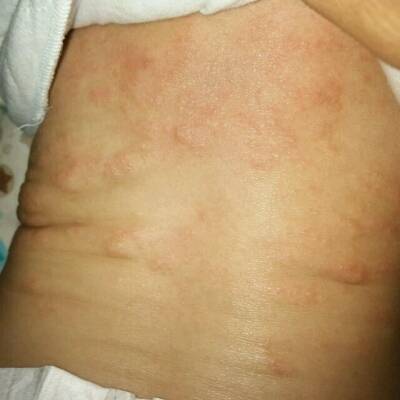 宝宝三个月了背上起的是不是乾性湿疹,怎麼治疗