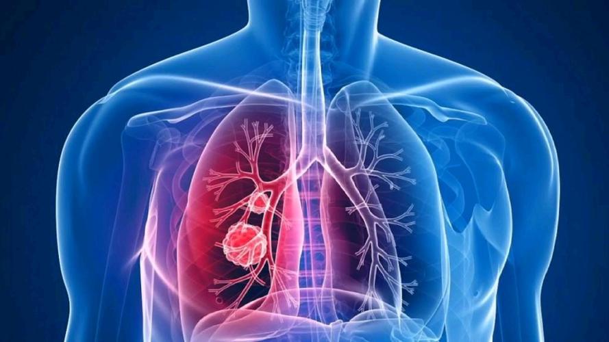 肺结节 肺肿物 肺肿瘤 肺肿块 肺占位是恶性的吗?