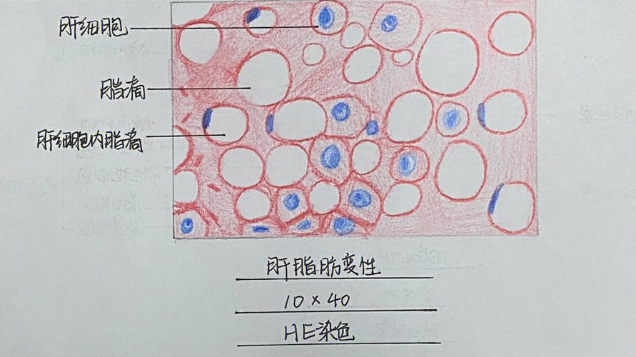 15纤维肉瘤46615肉芽组织(字丑勿喷～欢迎纠错～)#红蓝铅笔绘图