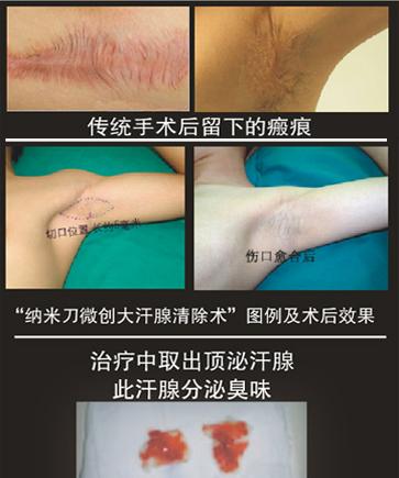 杭州新城医院 医院介绍 诊疗分析 外科  腋臭的治疗方法多种多样,用药