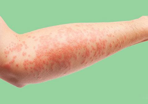 6种湿疹的类型和症状辨别图片大全_银屑病求医网