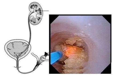 输尿管软镜钬激光碎石取石术01软性输尿管镜,可以到达输尿管上段甚至