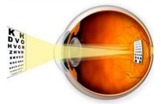 近视手术可以矫正散光?
