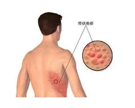 带状疱疹是由水痘-带状疱疹病毒引起的急性感染性皮肤病,这种病毒可以