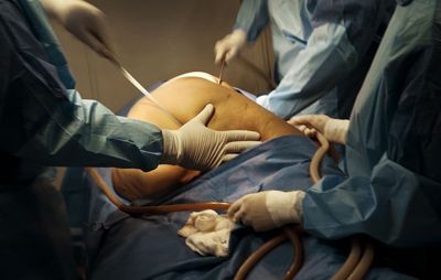 实拍乳房上提 全身吸脂手术(7)
