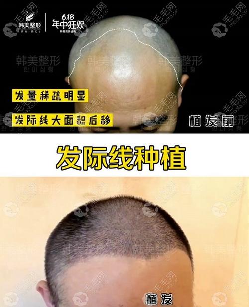 男士双额角植发六个月效果图!案例来源于怀化韩美植发医院_怀化韩美植