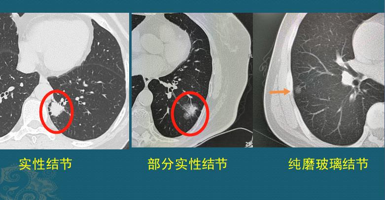 肺上有结节,5个细节揭示有没有癌细胞,医生叫你看ct片