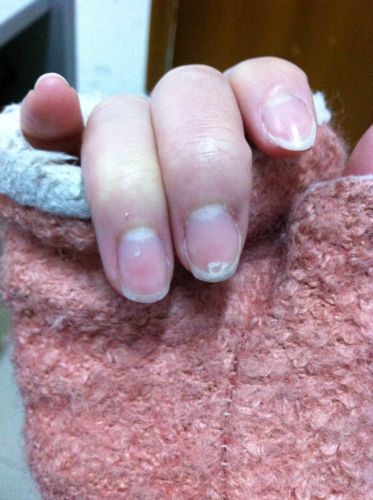 为什么指甲会出现一摊白色,最近出现的,而且长出来的指甲老是分层,留