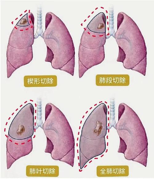 肺结节的四种手术方式(红色虚线为切除部分)结节的位置靠近肺部的周边