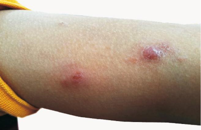 4 月女童全身反复出现皮疹,这种皮肤病你见过吗?