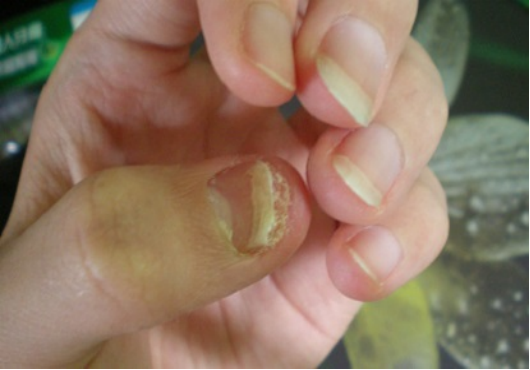 手指甲起层在临床上又称为指甲分层,由于外因导致的指甲分层多出现在